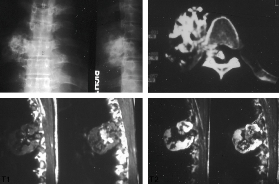 Figure 4 for case Chondrosarcoma ( RID4140 ) of the vertebral column